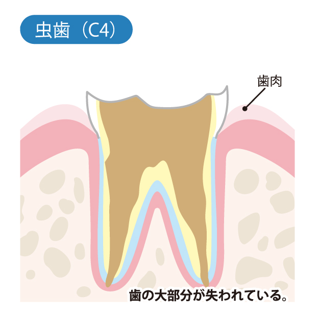 藤井寺駅南口アールズ歯科・歯周病クリニックで、むし歯治療