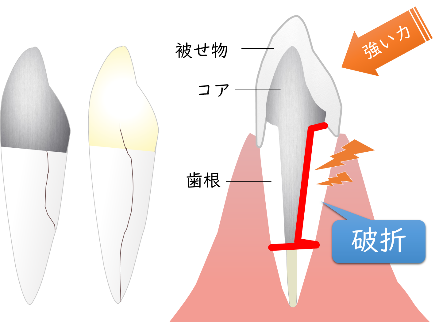 藤井寺駅南口アールズ歯科・歯周病クリニックの根管治療