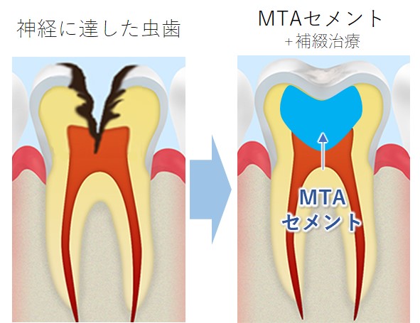 藤井寺駅南口アールズ歯科・歯周病クリニックの根管治療