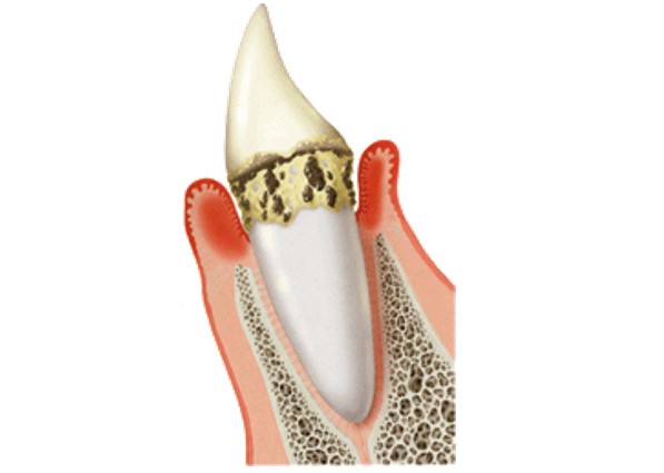  藤井寺駅南口アールズ歯科・歯周病クリニックの歯周病の症状と治療法