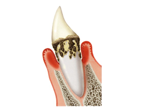  藤井寺駅南口アールズ歯科・歯周病クリニックの歯周病の症状と治療法