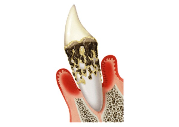  藤井寺駅南口アールズ歯科・歯周病クリニックの歯周病の症状と治療法