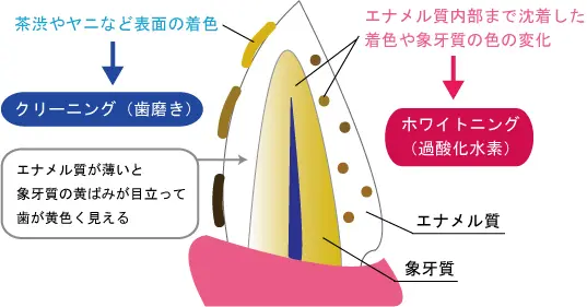 藤井寺駅南口アールズ歯科・歯周病クリニックで、ホワイトニング